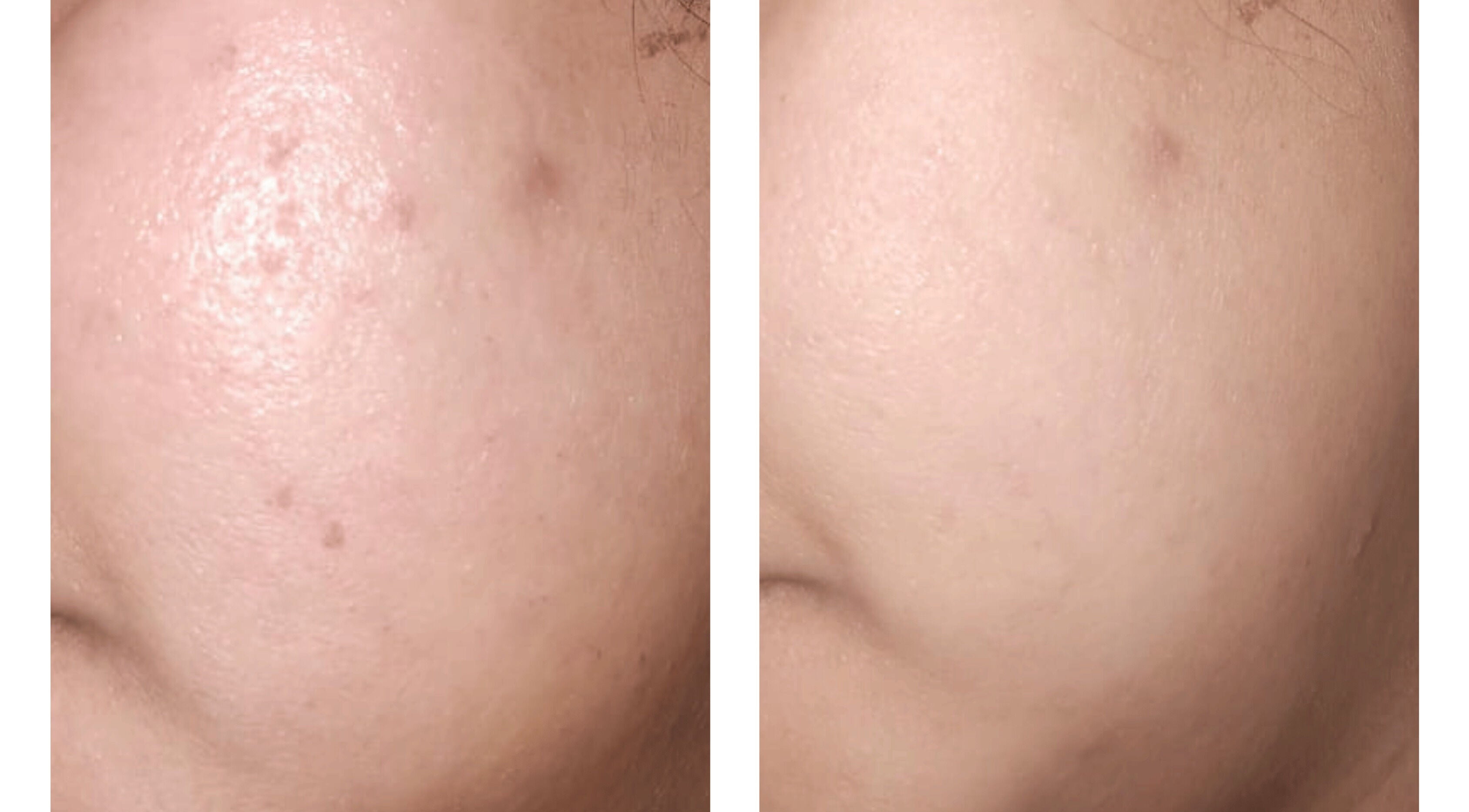 Clinical Skin Care results in Gasparillo, Couva-Tabaquite-Talparo, TT showing before and after skin improvement.
