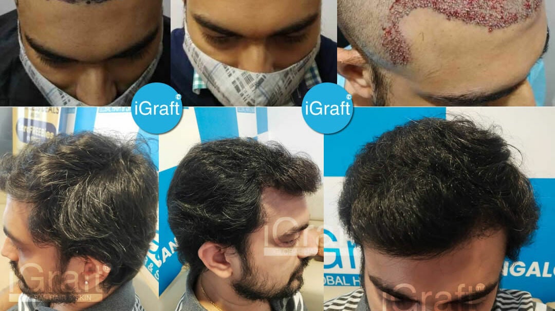 Cost of Hair Transplantation in India