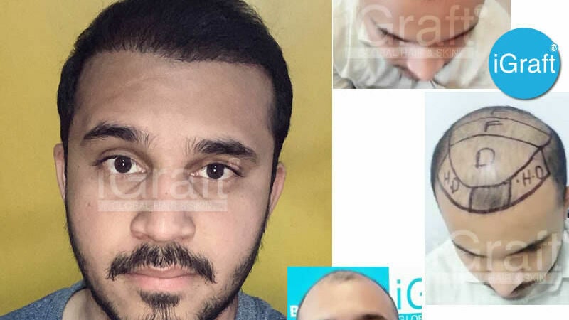 iGraft Best Hair Transplant Hyderabad and SKIN Treatments - Building 8/2/293/82/J III/369C, Road No 82, Film Nagar, Wine Mart, beside Vet & Pet Care Clinic - Hyderabad | Fresha iGraft Best Hair Transplant Hyderabad and SKIN Treatments - Building 8/2/293/82/J III/369C, Road No 82, Film Nagar, Wine Mart, beside Vet & Pet Care Clinic - Hyderabad | Fresha
