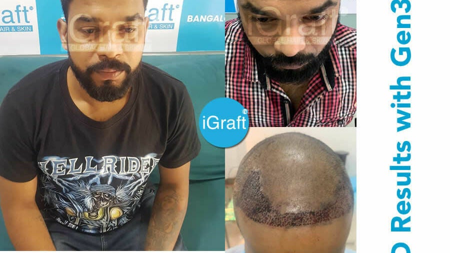 iGraft Best Hair Transplant Hyderabad and SKIN Treatments - Building 8/2/293/82/J III/369C, Road No 82, Film Nagar, Wine Mart, beside Vet & Pet Care Clinic - Hyderabad | Fresha iGraft Best Hair Transplant Hyderabad and SKIN Treatments - Building 8/2/293/82/J III/369C, Road No 82, Film Nagar, Wine Mart, beside Vet & Pet Care Clinic - Hyderabad | Fresha