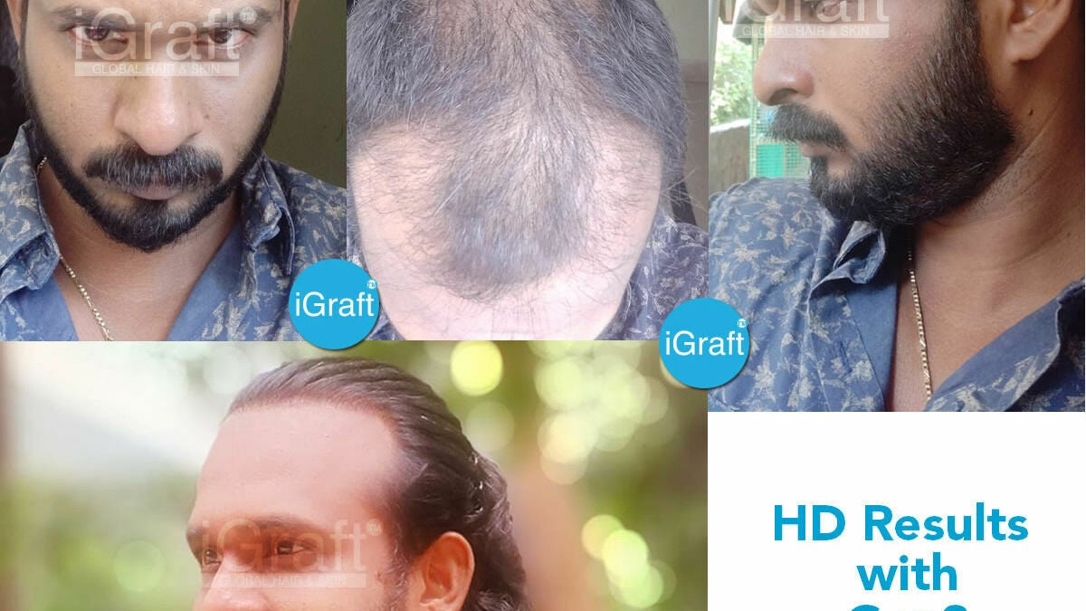 iGraft Best Hair Transplant Hyderabad and SKIN Treatments - Building 8/2/293/82/J III/369C, Road No 82, Film Nagar, Wine Mart, beside Vet & Pet Care Clinic - Hyderabad | Fresha iGraft Best Hair Transplant Hyderabad and SKIN Treatments - Building 8/2/293/82/J III/369C, Road No 82, Film Nagar, Wine Mart, beside Vet & Pet Care Clinic - Hyderabad | Fresha