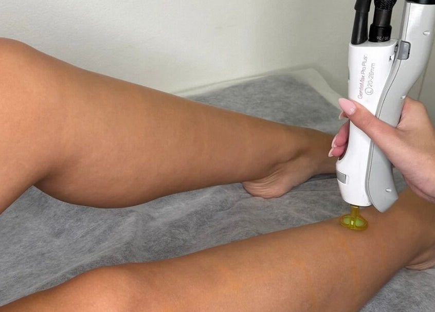 Leg laser treatment at Laser and Skin by Mabelle, Seven Hills, New South Wales, AU.