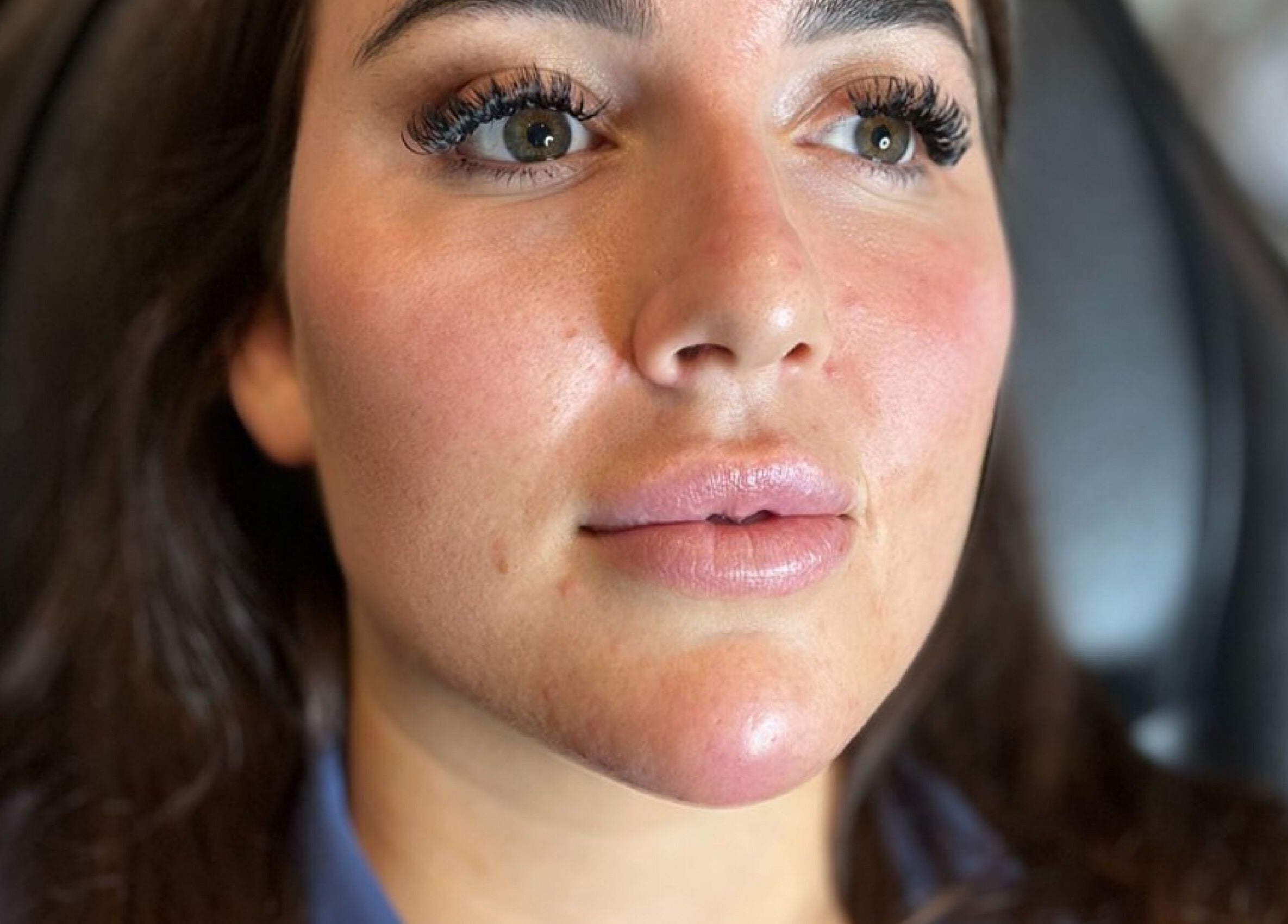 Facial treatment at Mediskin - Liverpool in Prescot, England, GB, showcasing natural beauty enhancement.