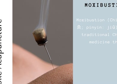 Moxibustion therapy at Bespoke Acupuncture Upper Street in London, England, GB. Traditional healing method.