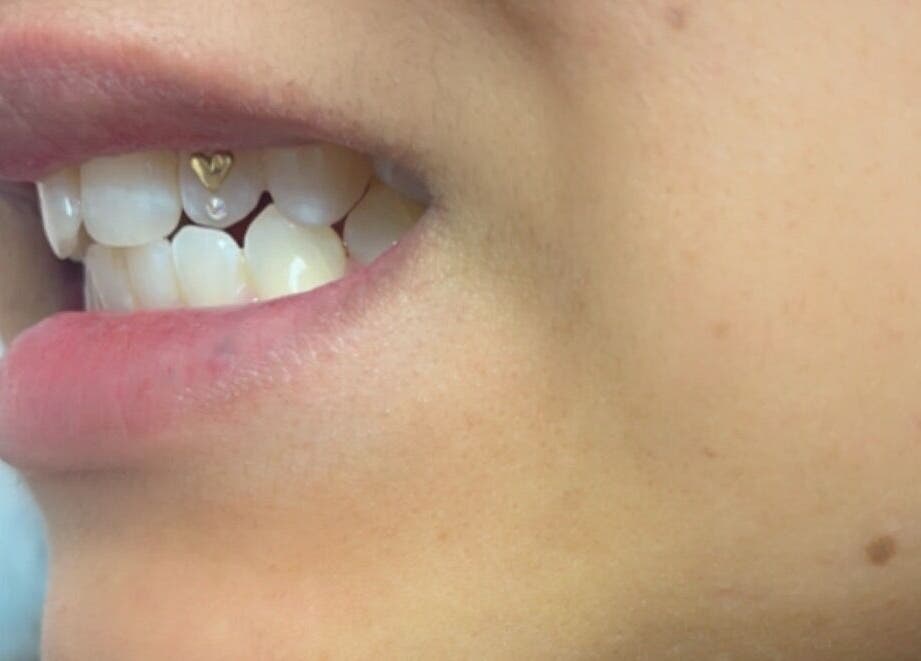 Close-up of a tooth gem design at Dazzling Beauty Lounge, Montgomery, Illinois, US.