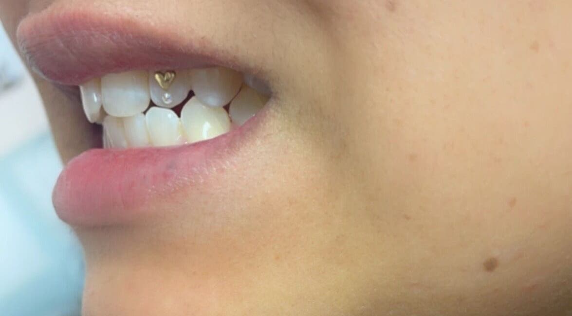 Close-up of a tooth gem design at Dazzling Beauty Lounge, Montgomery, Illinois, US.