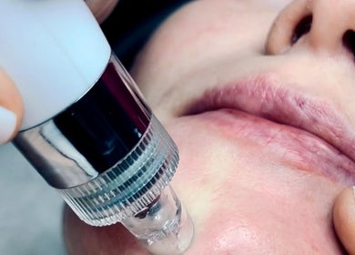 Close-up of microdermabrasion treatment at Facial Zen, Dublin, County Dublin, IE for smoother skin.