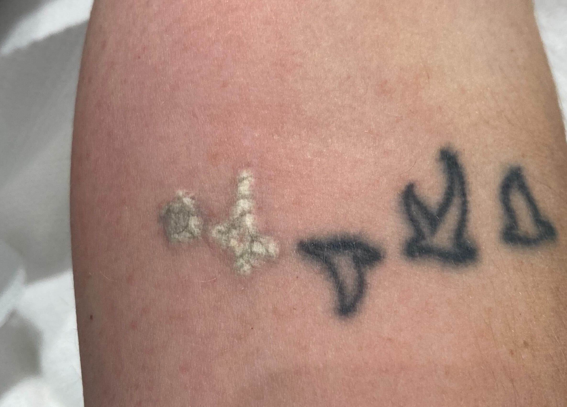 Arm tattoo fading treatment at Samantha Maunder Skin & Laser, Penarth, Wales, GB showing visible results.