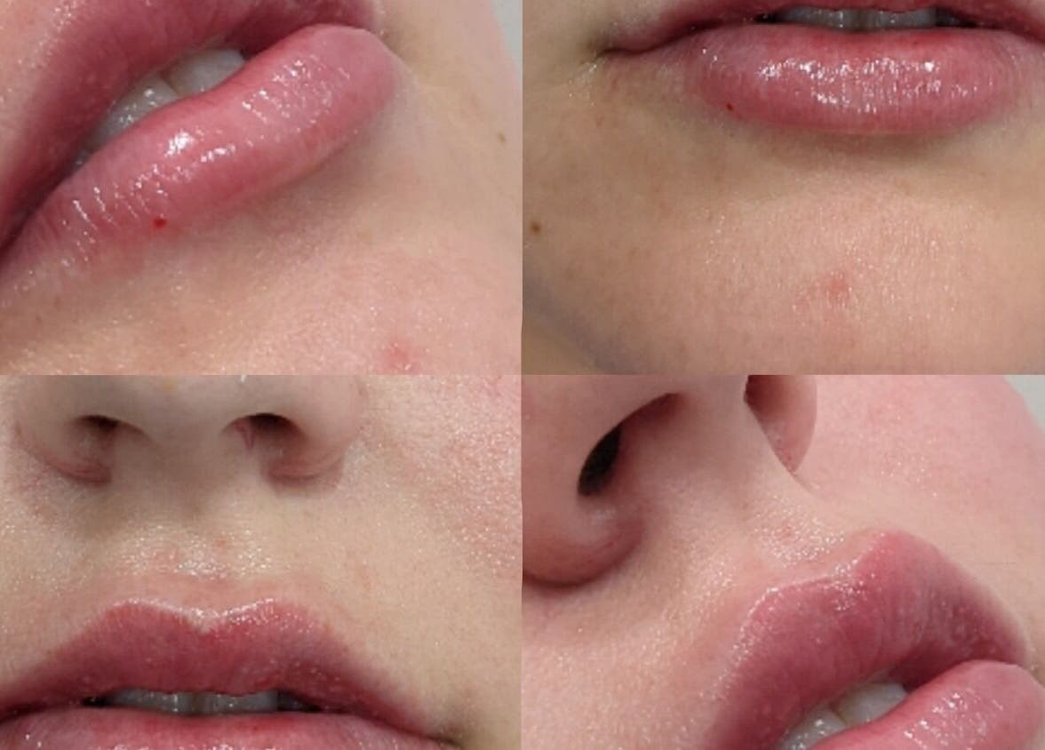 Close-up of lips post-treatment at Alpha Laser Clinics | Batlow in Batlow, New South Wales, AU.