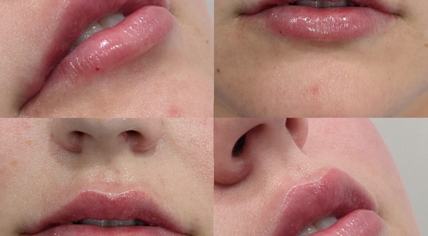 Close-up of lips post-treatment at Alpha Laser Clinics | Batlow in Batlow, New South Wales, AU.