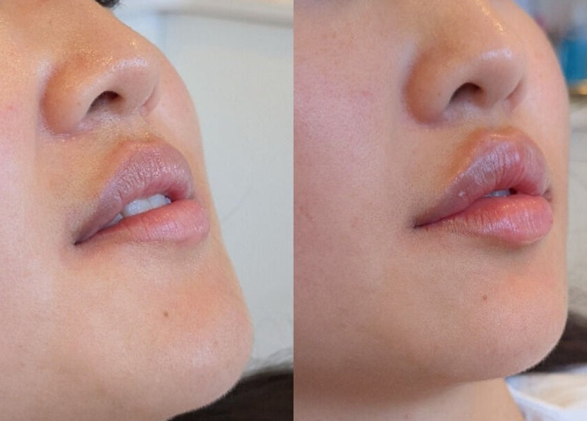 Before and after lip enhancement at Alpha Laser Clinics | Miranda, New South Wales, AU, showing plumper lips.