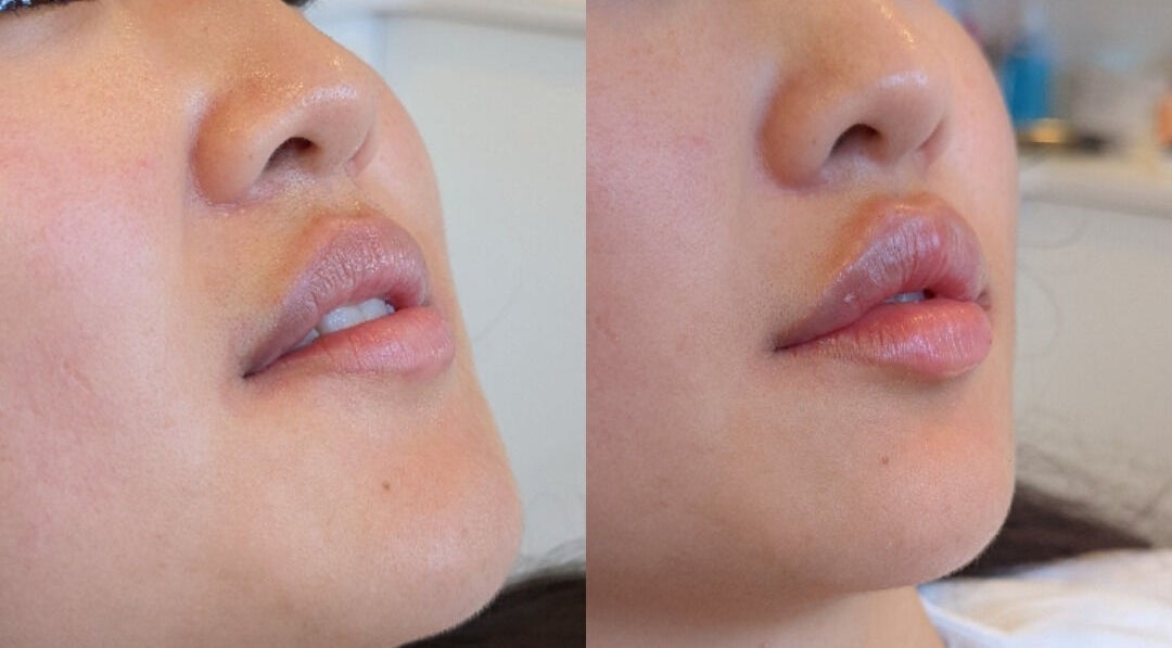 Before and after lip enhancement at Alpha Laser Clinics | Miranda, New South Wales, AU, showing plumper lips.