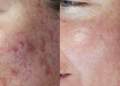 Before and after acne treatment at Lashes and Skin by Kirstie, Magherafelt, Northern Ireland, GB. Clearer skin results.