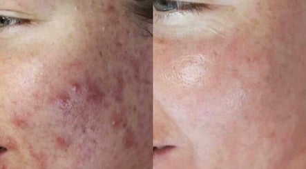 Before and after acne treatment at Lashes and Skin by Kirstie, Magherafelt, Northern Ireland, GB. Clearer skin results.
