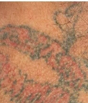 Original Skin Tattoo Removal CAMBERLEY – kuva 2