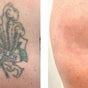 Original Skin Tattoo Removal