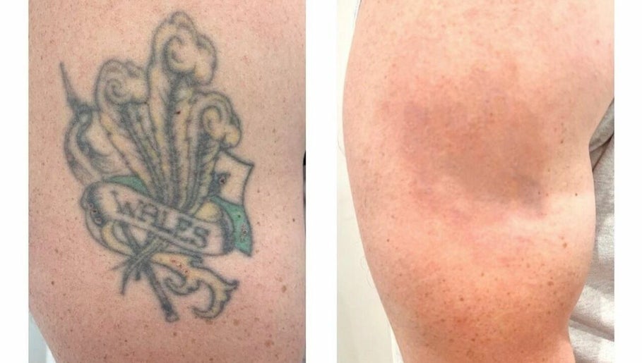 Original Skin Tattoo Removal – kuva 1