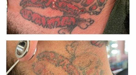 Original Skin Tattoo Removal – kuva 2