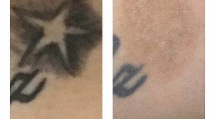Original Skin Tattoo Removal – kuva 3
