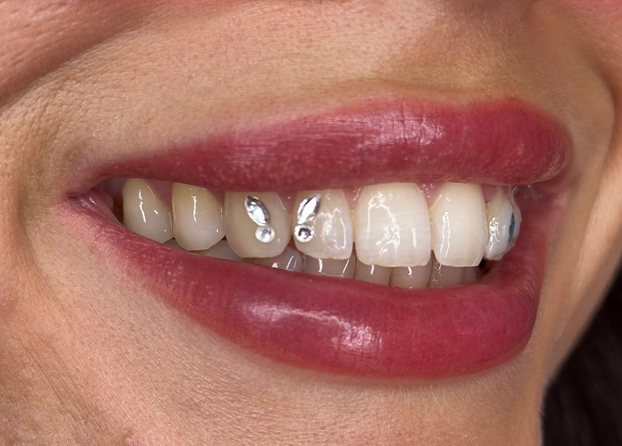 Close-up of a smile with pearly teeth and unique gems at Kglowstudio, London, England, GB.