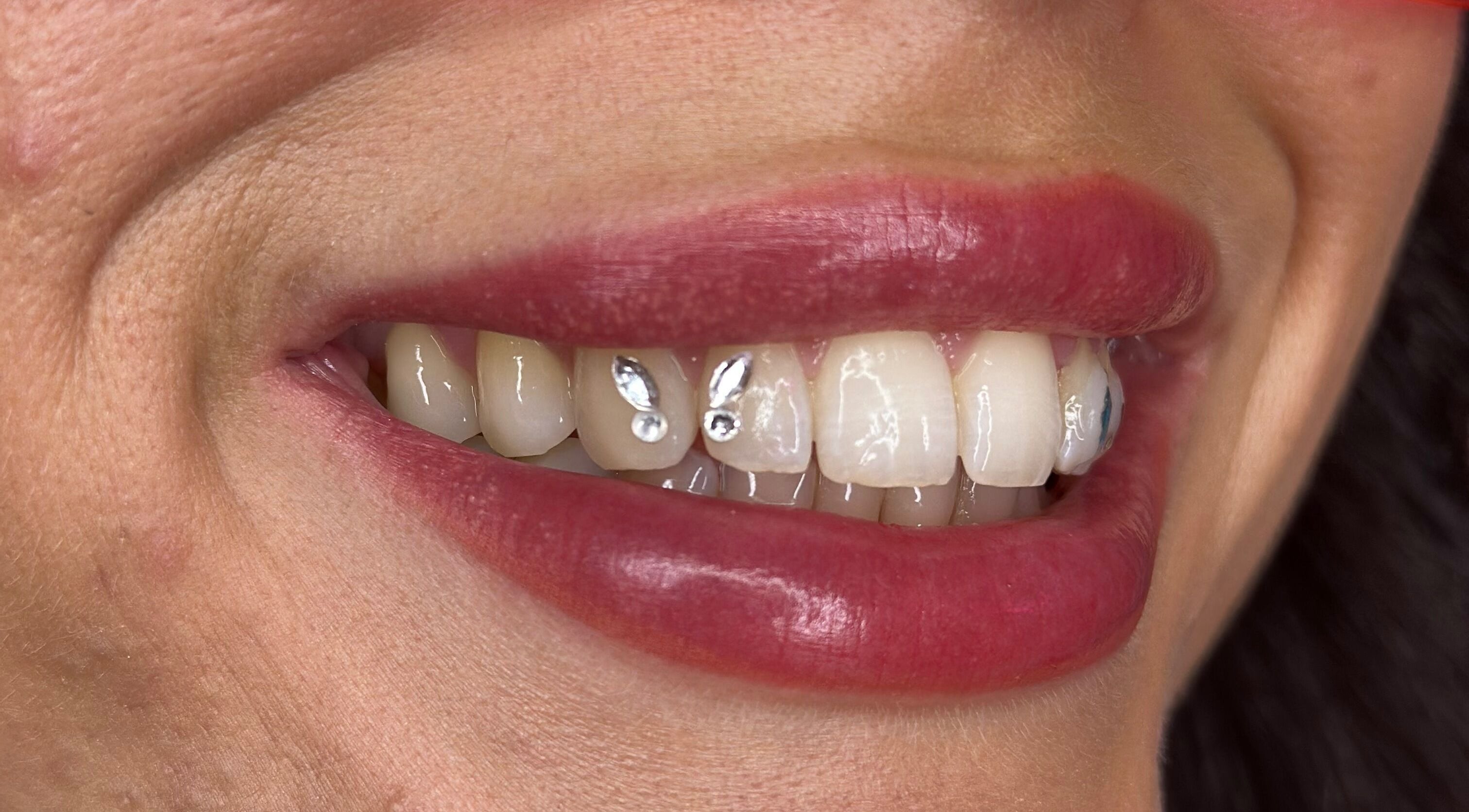 Close-up of a smile with pearly teeth and unique gems at Kglowstudio, London, England, GB.