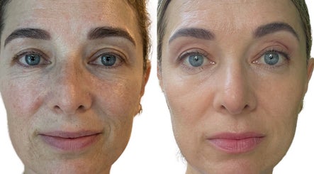 Before and after skincare results at Awakened Skin, North Miami, Florida, US showing radiant skin improvement.