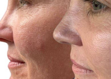 Close-up of skin transformation at Awakened Skin, North Miami, Florida, US.