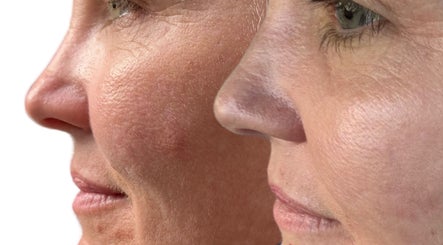 Close-up of skin transformation at Awakened Skin, North Miami, Florida, US.