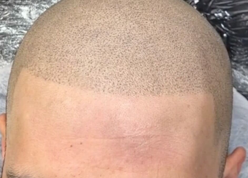 Micropigmentation du cuir chevelu chez Permanent Beauty by ZAHA à Casablanca, Casablanca-Settat, MA.