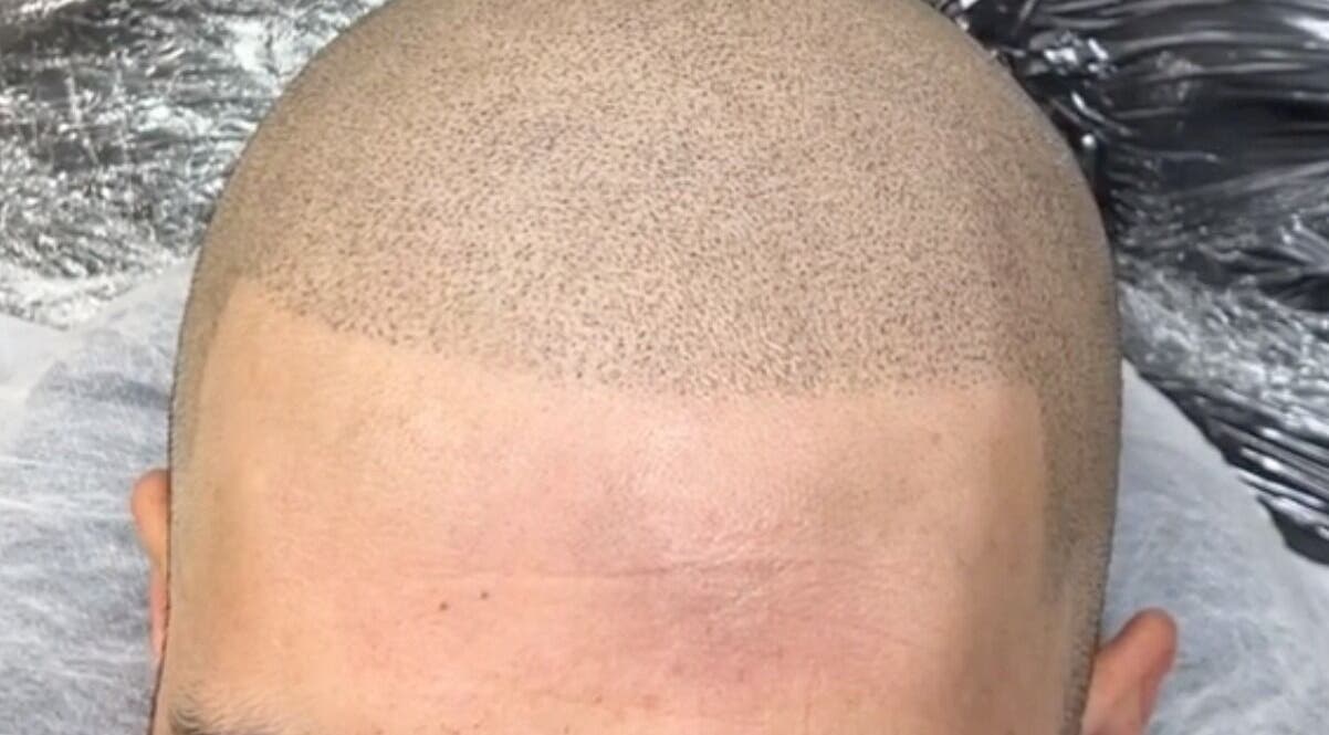 Micropigmentation du cuir chevelu chez Permanent Beauty by ZAHA à Casablanca, Casablanca-Settat, MA.