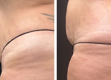 Before and after body contouring at Amethyst Ageless Studio, Stuart, Florida, US showing skin improvement.