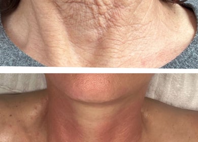 Before and after neck treatment at Amethyst Ageless Studio, Stuart, Florida, US, showcasing youthful skin.
