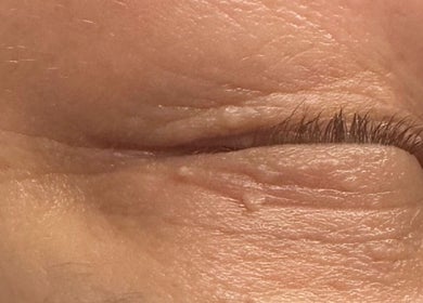 Close-up of an eyelid after treatment at Amethyst Ageless Studio in Stuart, Florida, US.