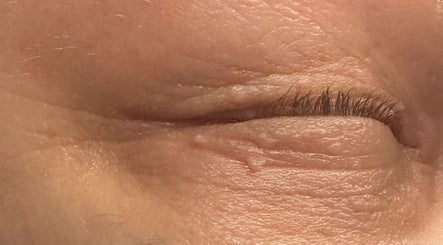 Close-up of an eyelid after treatment at Amethyst Ageless Studio in Stuart, Florida, US.