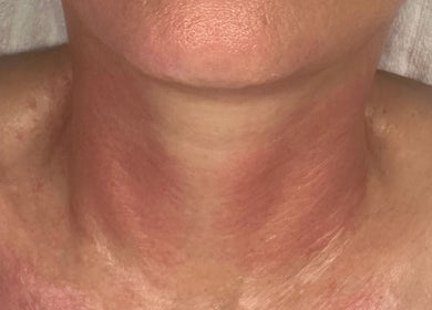 Neck rejuvenation treatment at Amethyst Ageless Studio in Stuart, Florida, US, showcasing enhanced skin texture.
