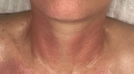 Neck rejuvenation treatment at Amethyst Ageless Studio in Stuart, Florida, US, showcasing enhanced skin texture.