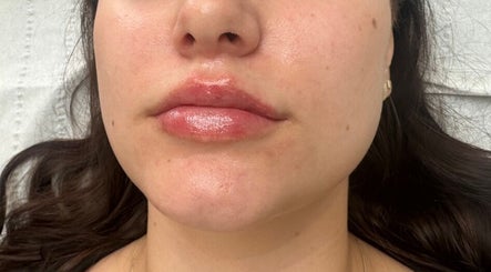 Lip enhancement treatment at Nu Skin Clinic, London, England, GB showcasing glossy, smooth lips.