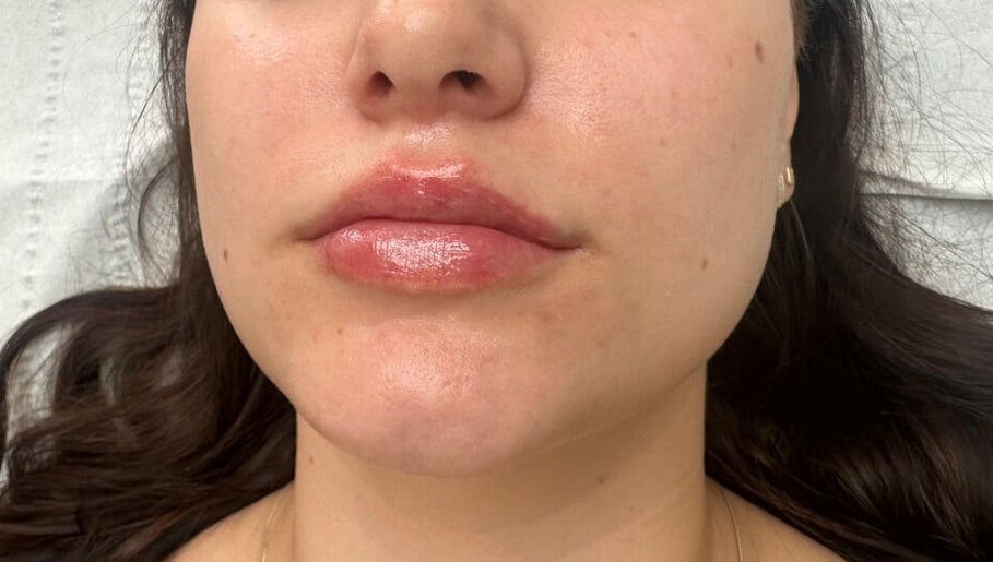 Close-up of glossy enhanced lips at Nu Skin Clinic, London, England, GB.