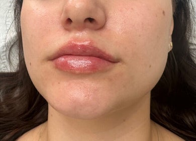 Close-up of glossy enhanced lips at Nu Skin Clinic, London, England, GB.