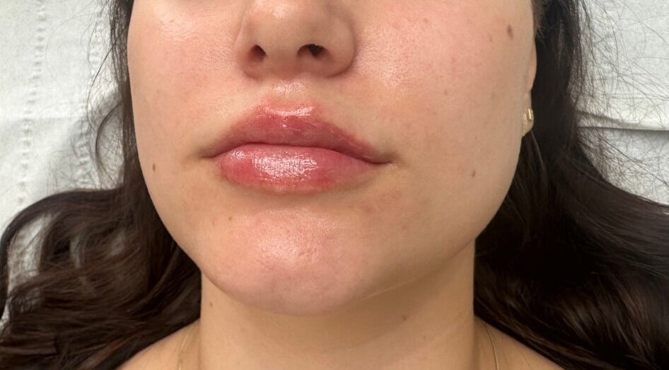 Close-up of glossy enhanced lips at Nu Skin Clinic, London, England, GB.