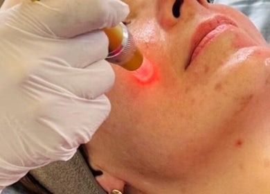 Laser facial treatment at Nu Skin Clinic, London, England, GB. Experience rejuvenating skincare services.