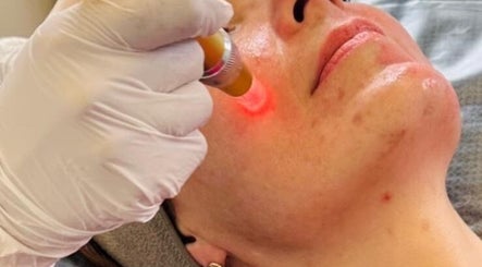 Laser facial treatment at Nu Skin Clinic, London, England, GB. Experience rejuvenating skincare services.