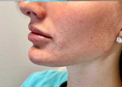 Close-up of glowing skin post-treatment at Nu Skin Clinic, London, England, GB.