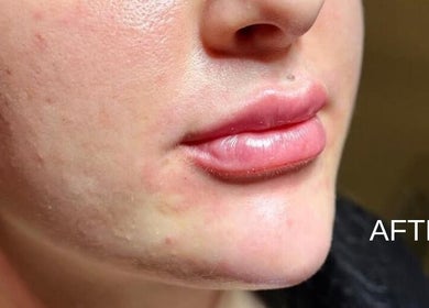 Close-up of treated skin and smooth lips at Nu Skin Clinic, London, England, GB.