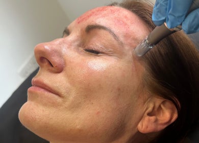 Microneedling treatment at Nu Skin Clinic, London, England, GB enhancing facial skin for a rejuvenated glow.