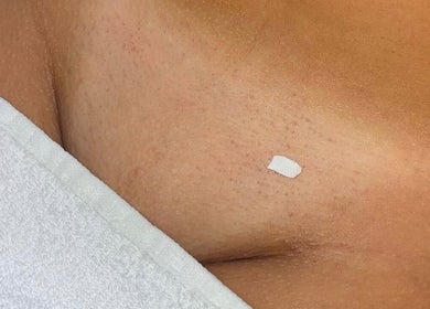 Close-up of skin treatment at Glow Skin Bar in Newcastle, England, GB, highlighting a clear complexion.