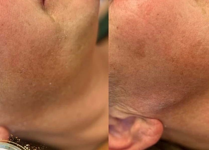 Before and after skin treatment at Aquarius Artistry and Aesthetics, Springside, Scotland, GB. Noticeable skin improvement.