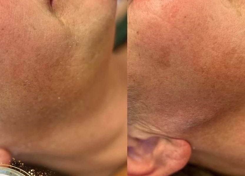 Before and after skin treatment at Aquarius Artistry and Aesthetics, Springside, Scotland, GB. Noticeable skin improvement.