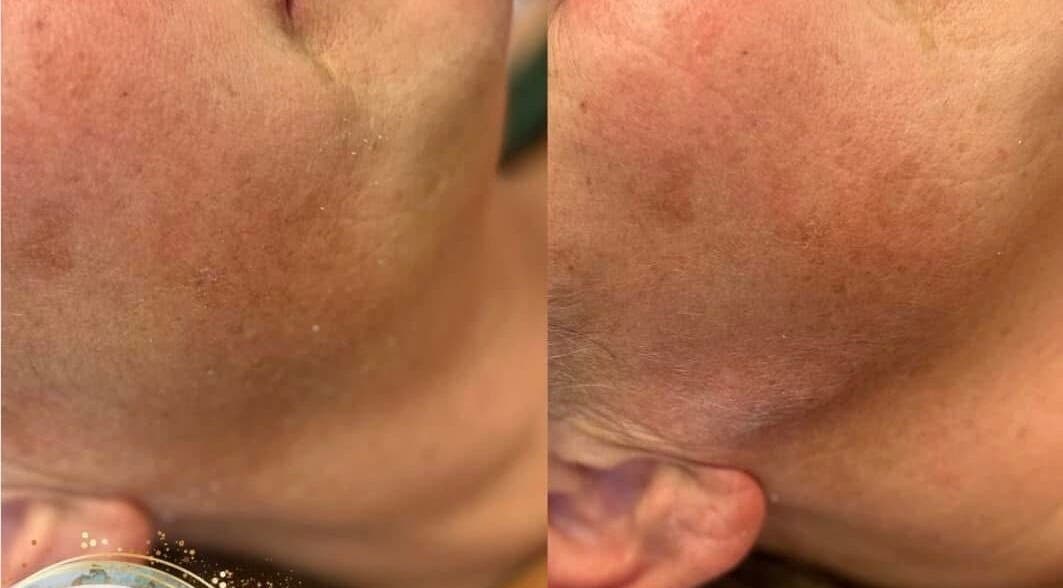 Before and after skin treatment at Aquarius Artistry and Aesthetics, Springside, Scotland, GB. Noticeable skin improvement.