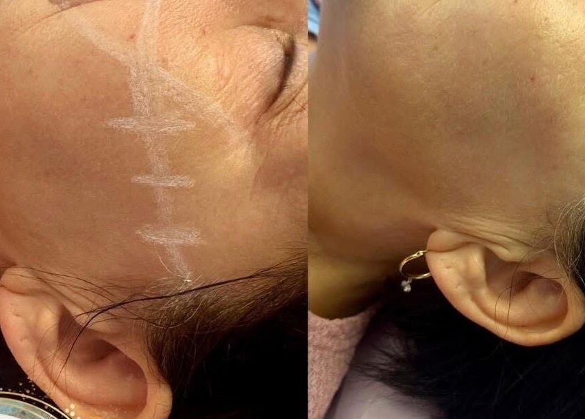 Before and after facelift at Aquarius Artistry and Aesthetics, Springside, Scotland, GB showcasing remarkable results.